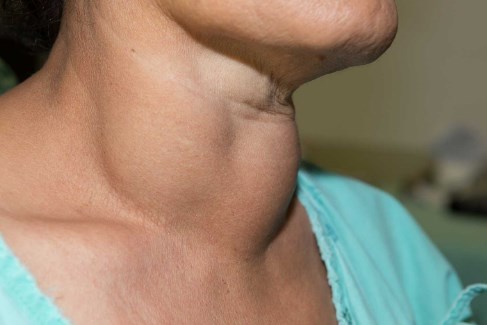 thyroid food symptoms ayurvedic